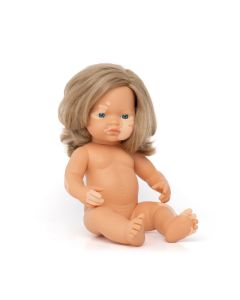 Baby Doll with Vitiligo