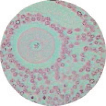 Ovary - Pregnant With Corpus Luteum