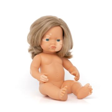 Baby Doll with Vitiligo